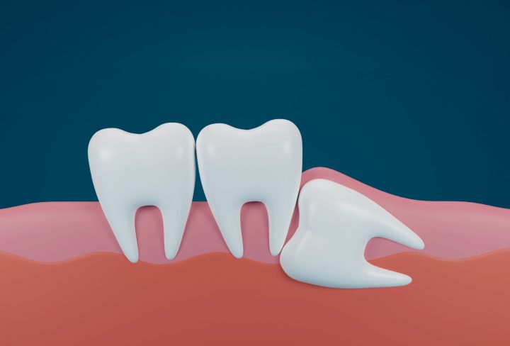 3d-render-teeth-with-wisdom-mesial-impaction