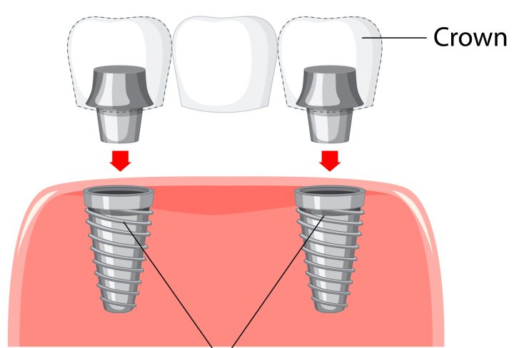 Infographic of human in structure of the dental implant illustration