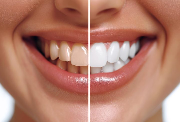 Teeth Whitening