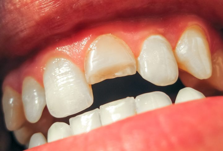 Broken tooth. Broken upper incisor in a man mouth. Man shows oral cavity to the dentist. Treatment of a broken tooth.