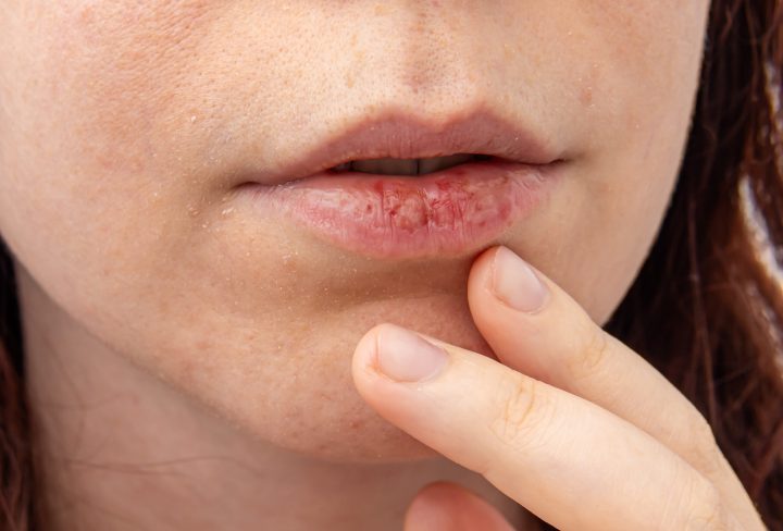 Dry skin on face and dry chapped lips. Cracked female lips